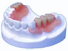 Löst sich nicht zahnprothese Zahnprothese klemmt